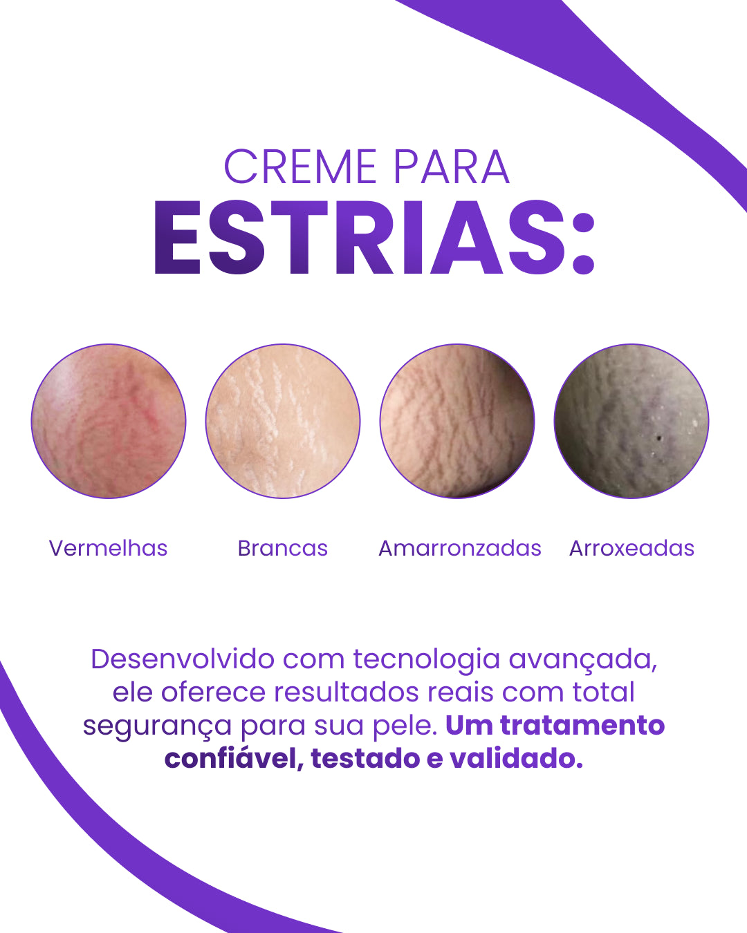 Daily Tratamento - Creme Para Estrias